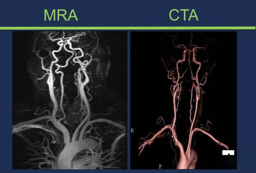 只有自己努力 颈内动脉 大脑中动脉  大脑前动脉 heubner返动脉