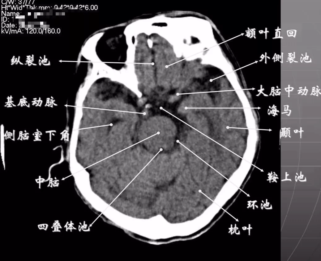 简明又详细的头部ct读片详解收藏