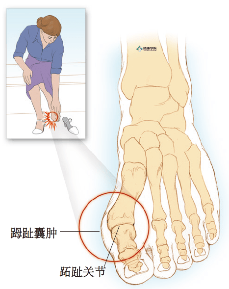 如果怀疑有关节不稳,隐匿性肿块或肿瘤,应该进行脚趾mri检查.