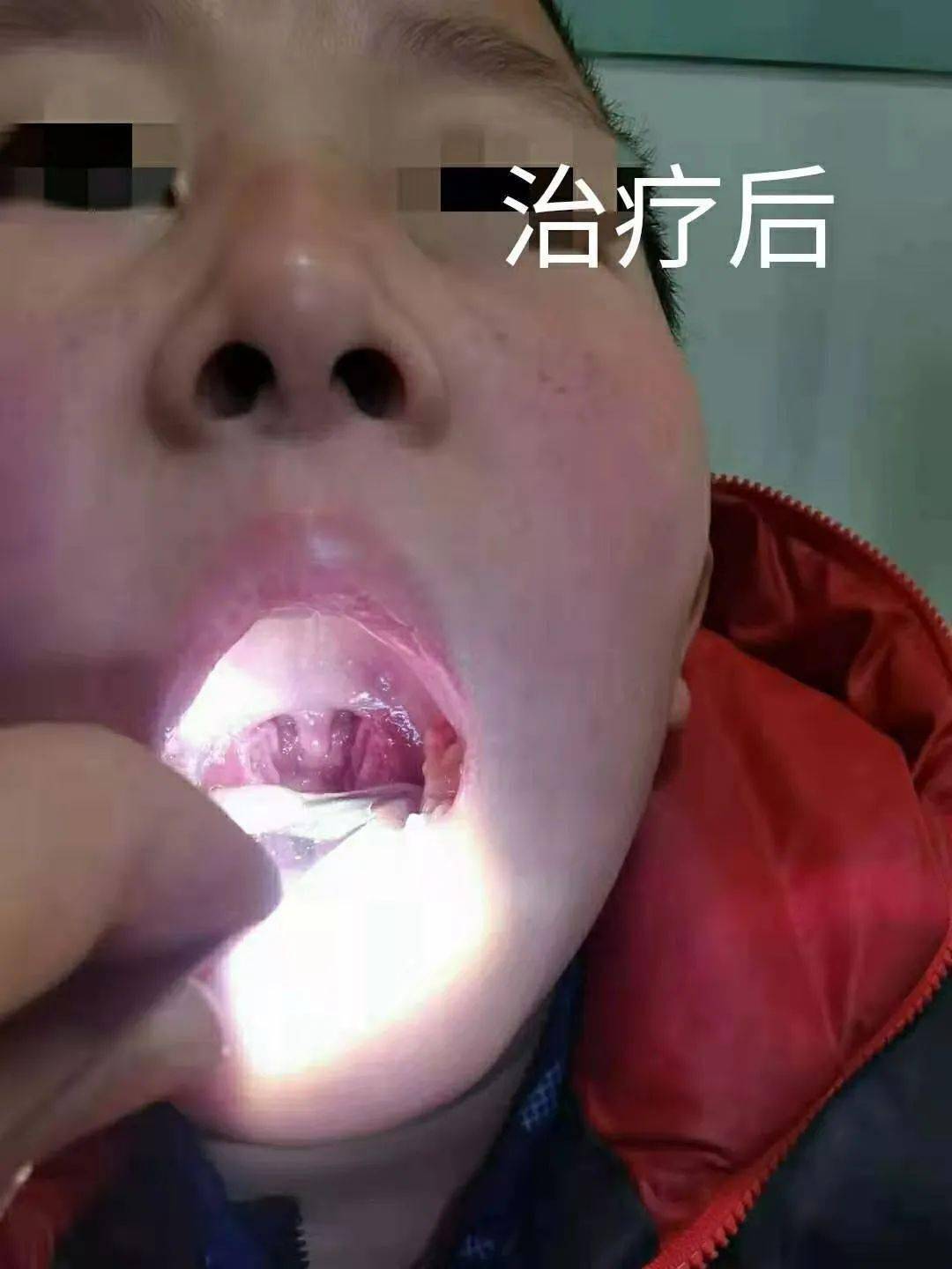 包括慢性扁桃体肿大反复发作,喉源性咳嗽,咽部异物感,咽后壁淋巴滤泡