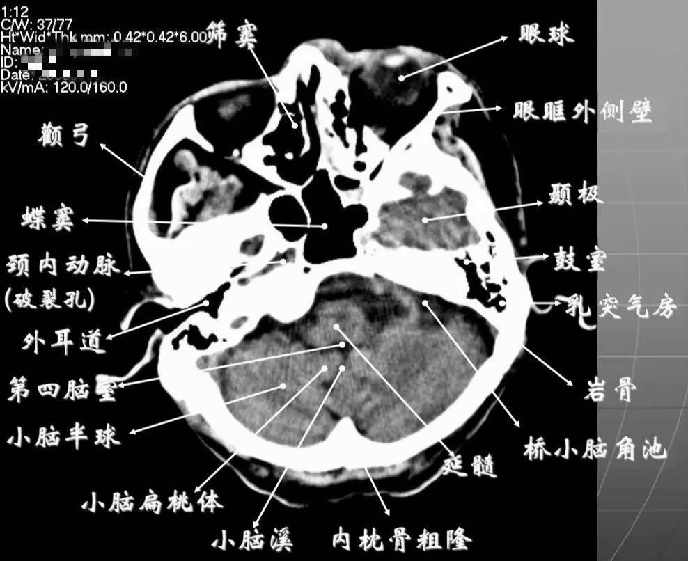 简明又详细的头部ct读片详解,收藏