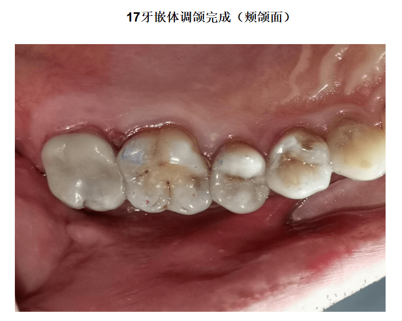 【病例】上颌第二恒磨牙大面积磨耗emax瓷嵌体微创修复