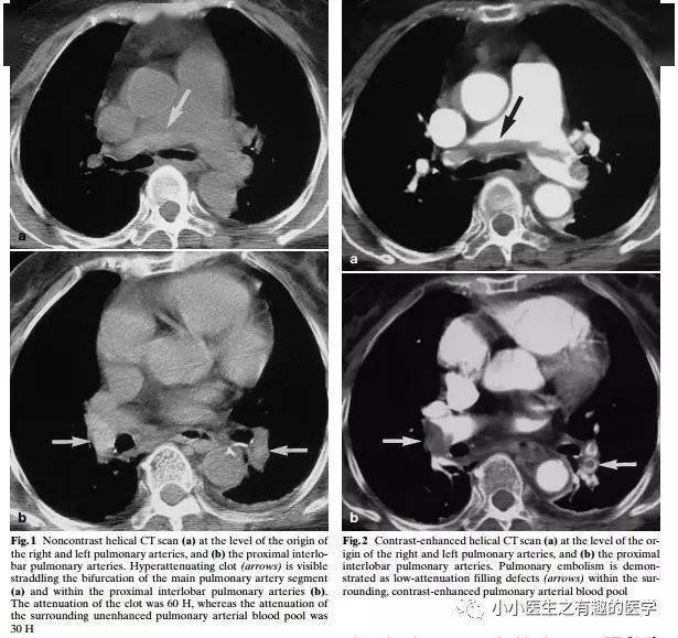 肺栓塞提高篇:ct平扫可发现,甚至诊断肺栓塞,看看国外高手论肺栓塞