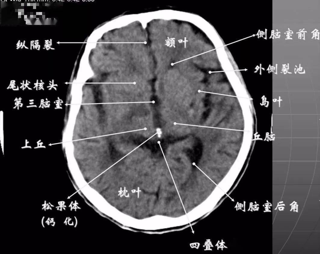 简明又详细的头部ct读片详解!