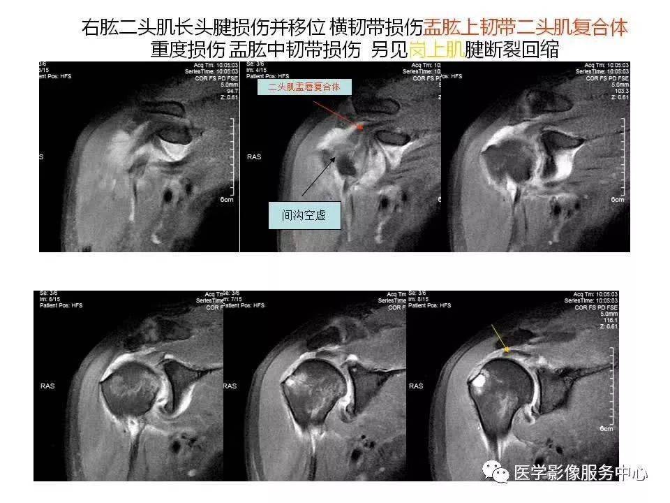 肩关节韧带及损伤的mr表现