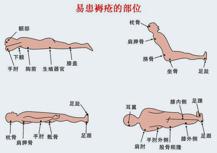 【科普】压疮(褥疮)重在预防,请记住这些做法!