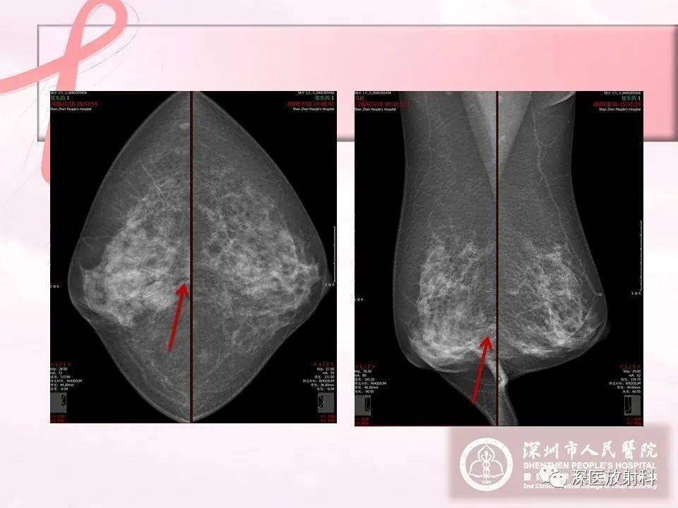 乳腺影像学征象解析_放射科