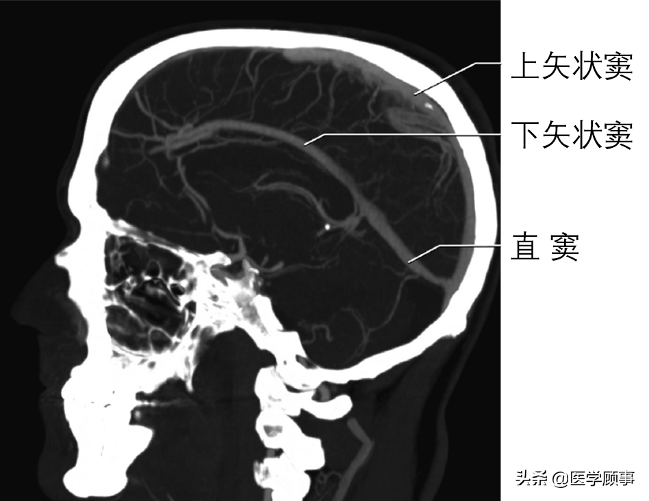 下图ctv可见上矢状窦额部发育不全,额叶的静脉回流主要流向下矢状窦