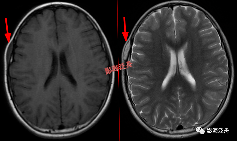 超级干货颅脑mr中易漏诊点全面总结