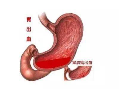 三,胃出血:胃出血是胃溃疡的严重症状,常常可导致失血性贫血及休克等