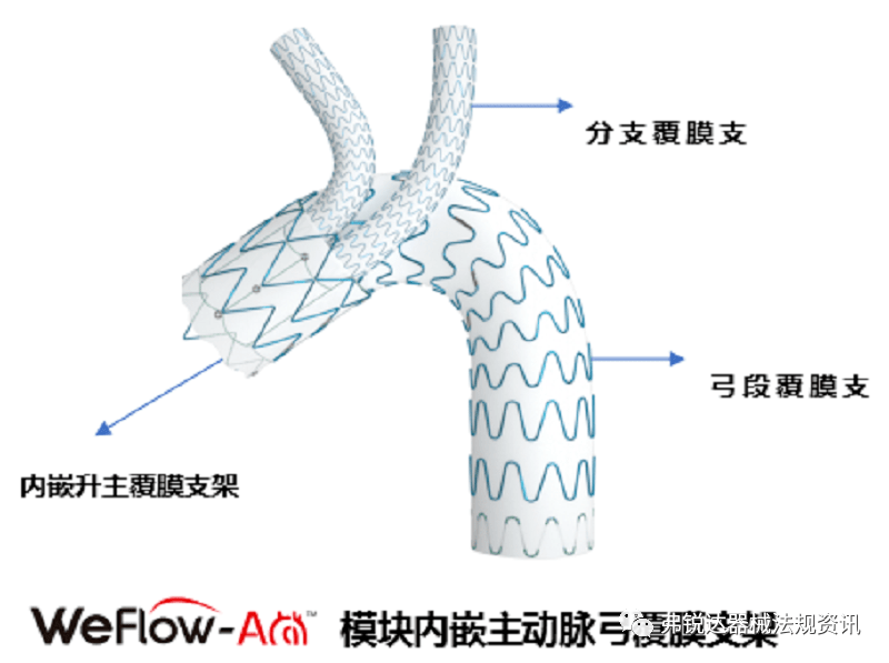 浙江i模块内嵌主动脉弓覆膜支架系统通过创新医疗器械特别审批申请