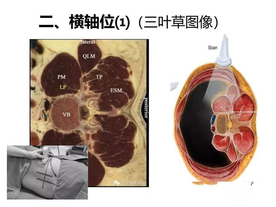 超声引导下腰丛神经阻滞