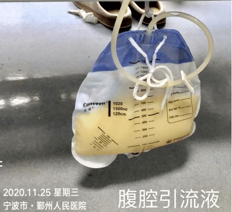 这种乳糜样腹水常漏诊,你见过吗?_腹腔镜