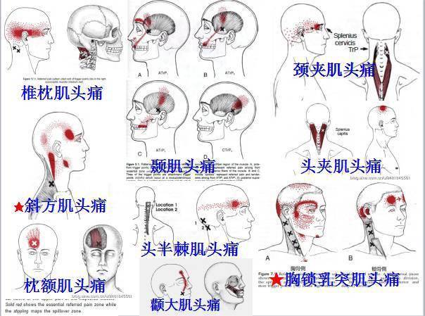 (sternocleidomastoid, sternal)  颞肌(temporalis)  头夹肌(sp