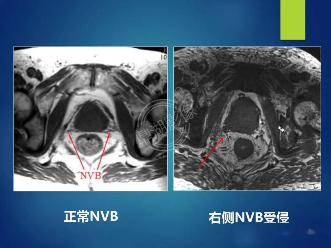 前列腺癌的磁共振成像诊断