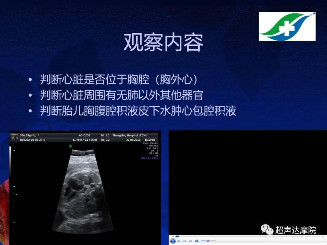 胎儿超声心动图基础及切面
