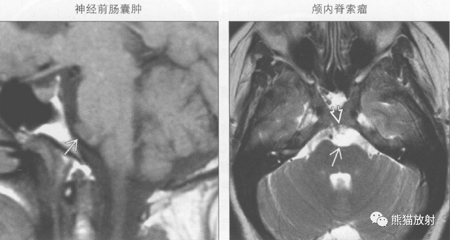 鉴别诊断丨桥前池肿块