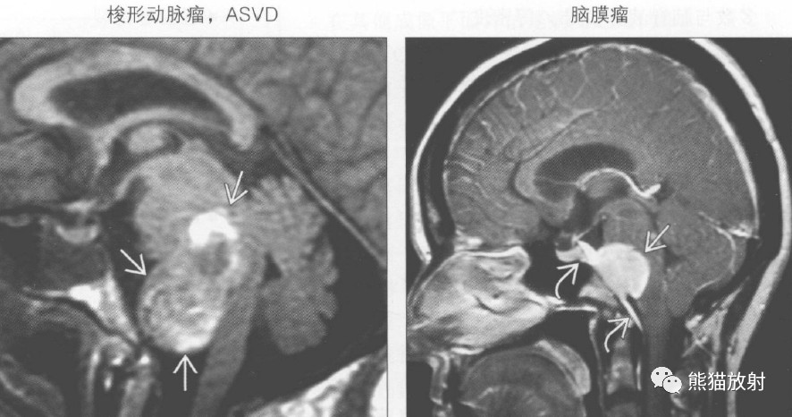 鉴别诊断丨桥前池肿块