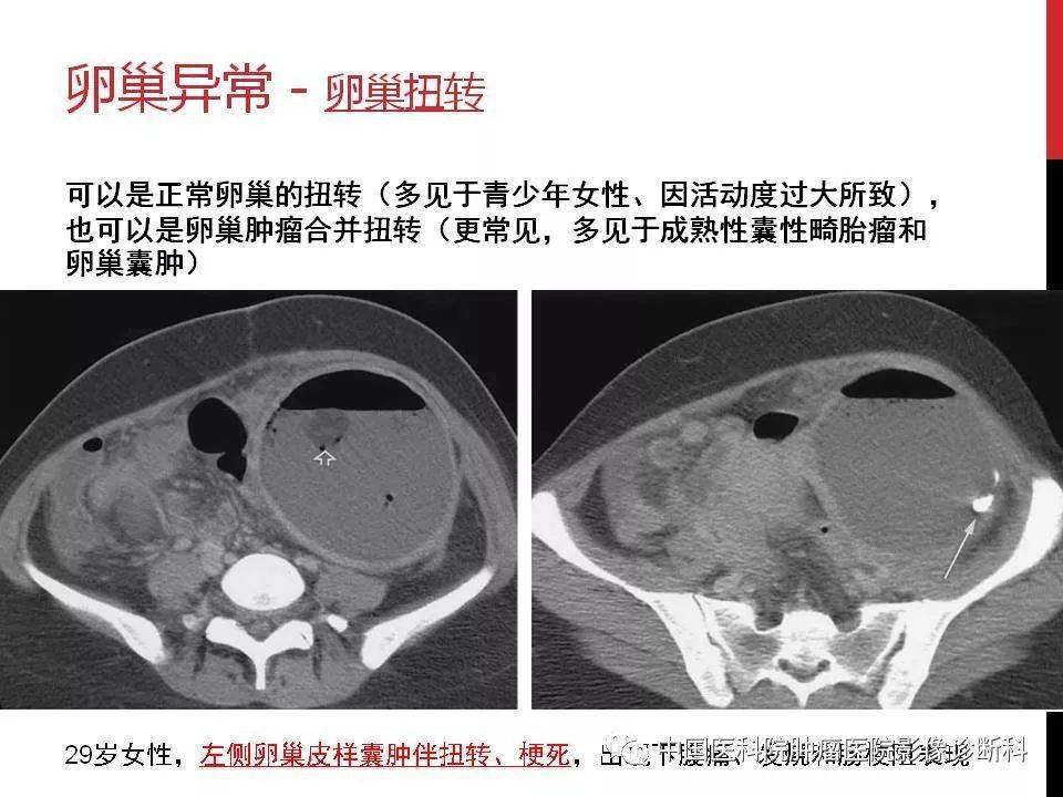 观察盆腔积液情况,了解怀孕情况及孕囊位置);·ct是必要补充(观察范围