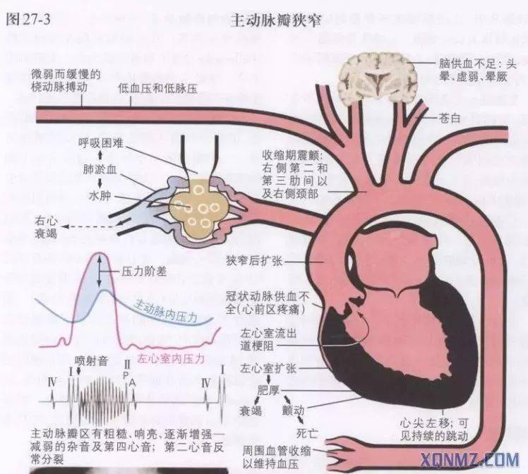 但临床上最常见出现晕厥的心瓣膜病为主动脉瓣狭窄,约有1/3的患者可