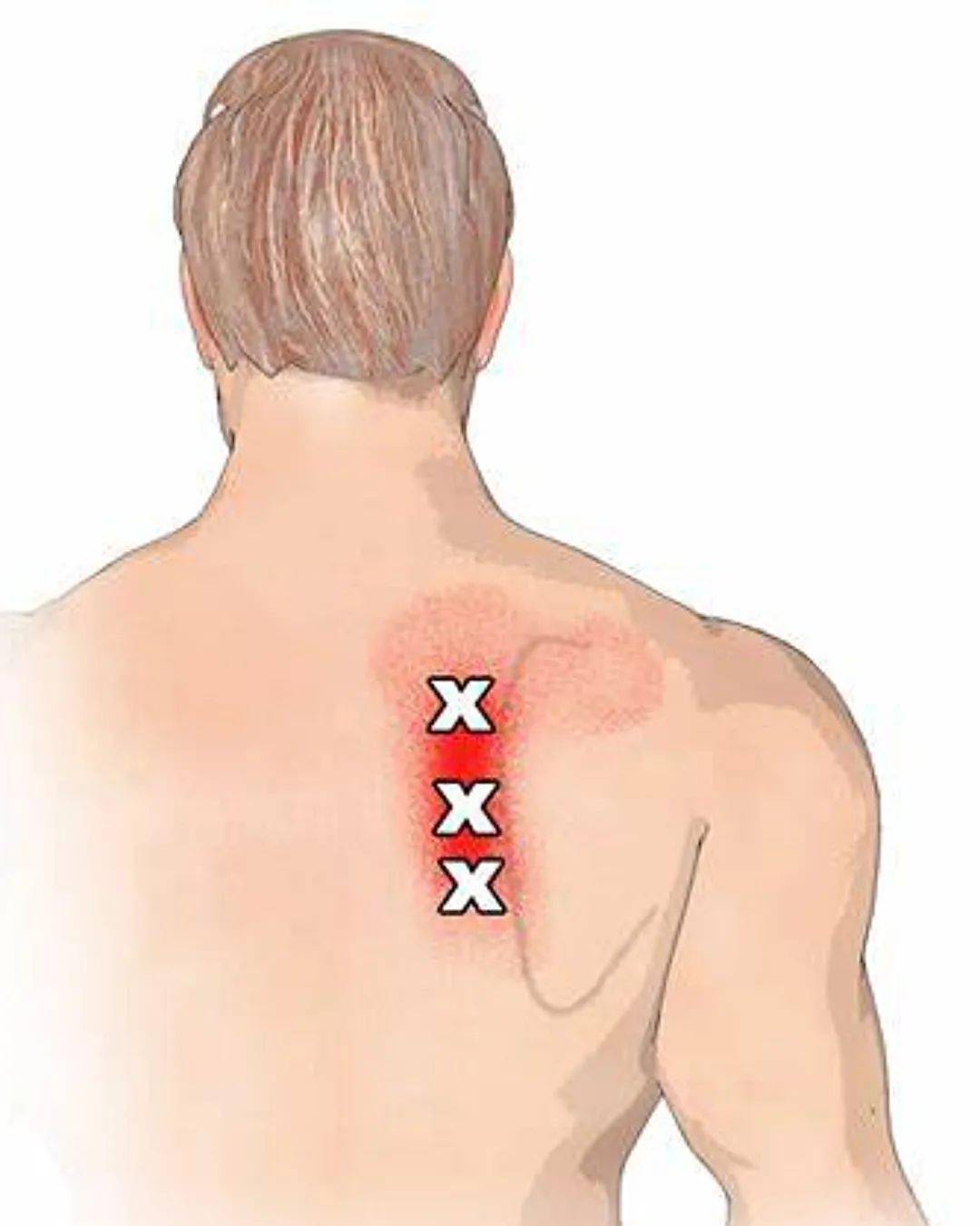 肩部内侧疼痛的关键肌——菱形肌