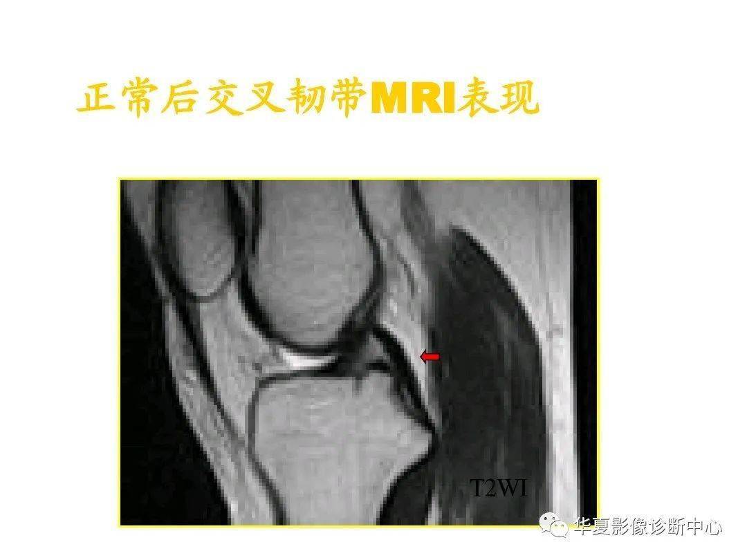 交叉韧带解剖及损伤的mri诊断