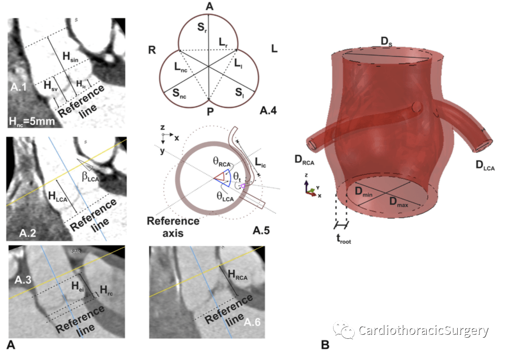 jtcvs丨冠状动脉主动脉起源异常的生物力学建模面向临床应用