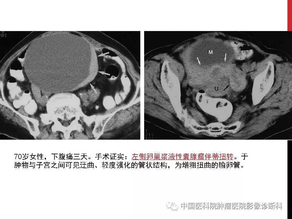 观察盆腔积液情况,了解怀孕情况及孕囊位置·ct是必要补充(观察范围