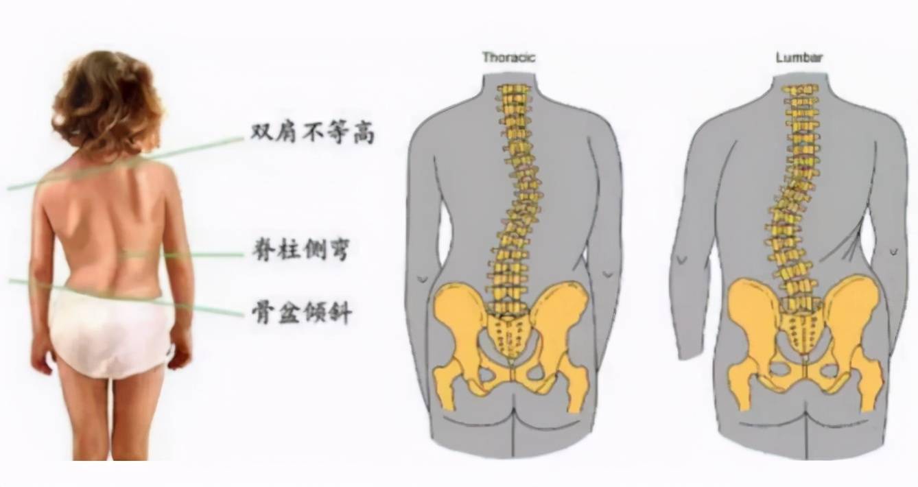 为什么现在孩子脊椎容易变形?多半因为宝妈的这3种行为,请住手