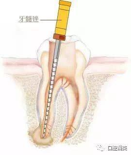 一看就懂牙齿根管治疗全过程图解