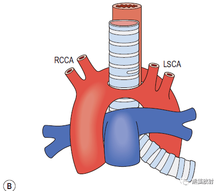 正常位置的左或前动脉弓穿出心包,发出左锁骨下动脉后连接左边的降主