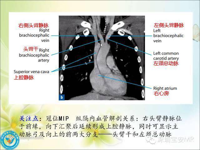 推荐丨肺动脉和肺静脉影像断层解剖