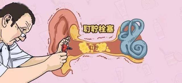 耵聍栓塞是什么 来自搜狐网