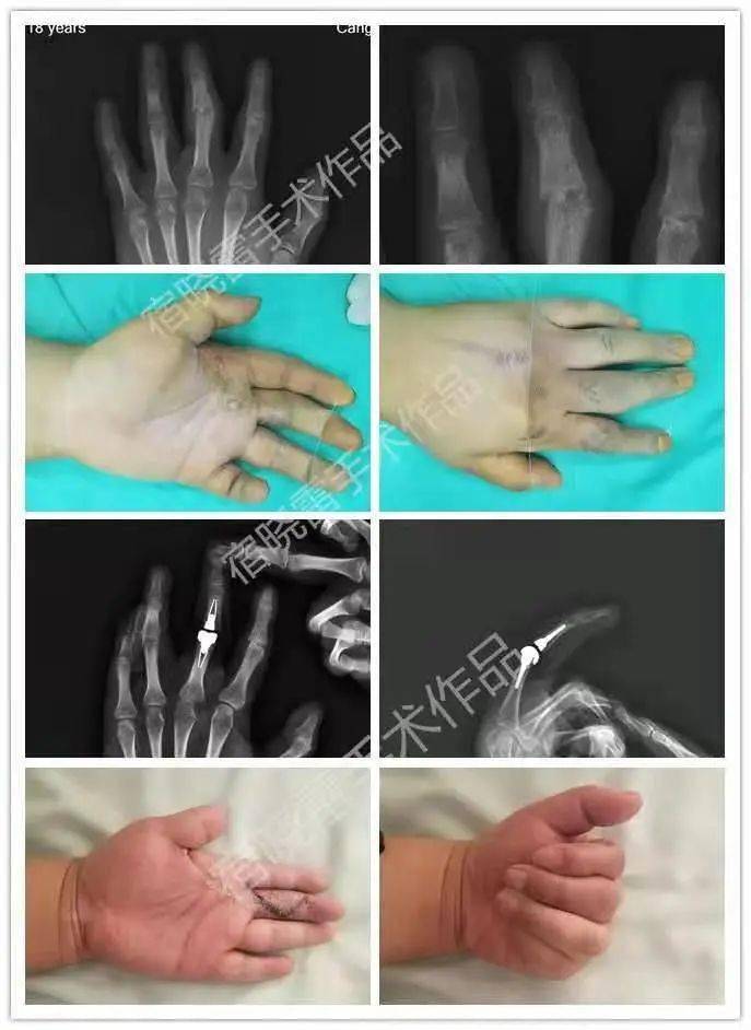 "患者左手中指以前受过伤,造成了创伤性关节炎,手指变形不能活动.