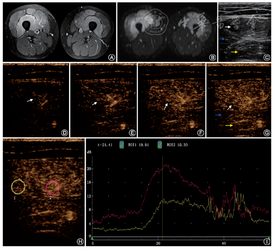 【神经肌肉病】超声造影在运动性横纹肌溶解综合征中的应用