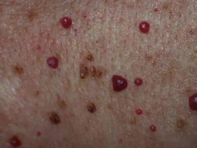 樱桃状血管瘤在开始时一般只有芝麻粒大小,像是在皮肤上长出来的红色