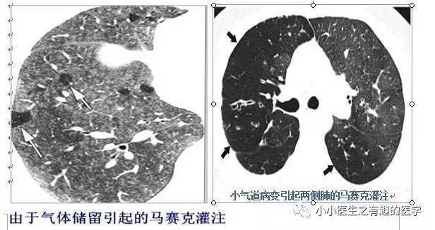 肺栓塞提高篇:ct平扫可发现,甚至诊断肺栓塞,看看国外