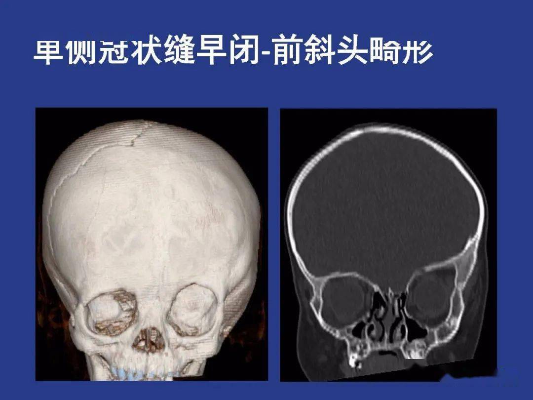 颅骨正常及常见变异的影像学表现