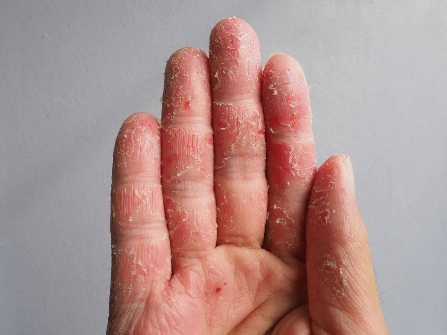 湿疹/皮炎:这是手部脱皮最常见的一大类疾病.