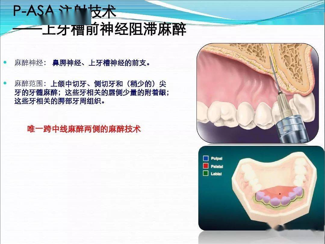 如何实现安全舒适口腔麻醉