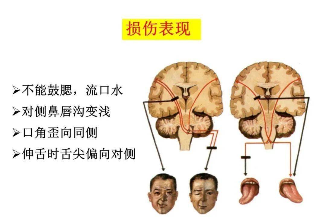 【收藏】脑干内部超详细功能解剖图