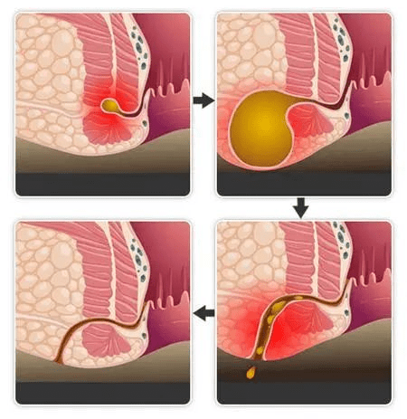 屁股长包,溢液老不好,可能肛瘘了!