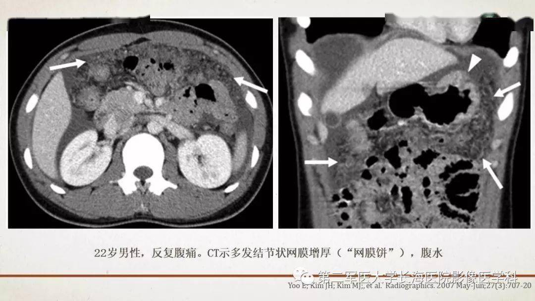 腹膜相关结构的影像解剖