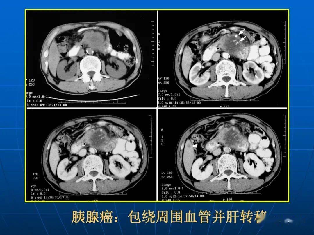 9种胰腺常见疾病的ct诊断