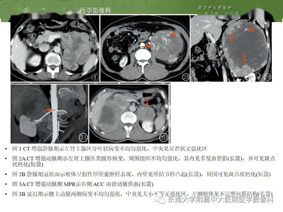 肾上腺嗜铬细胞瘤ct诊断与鉴别诊断