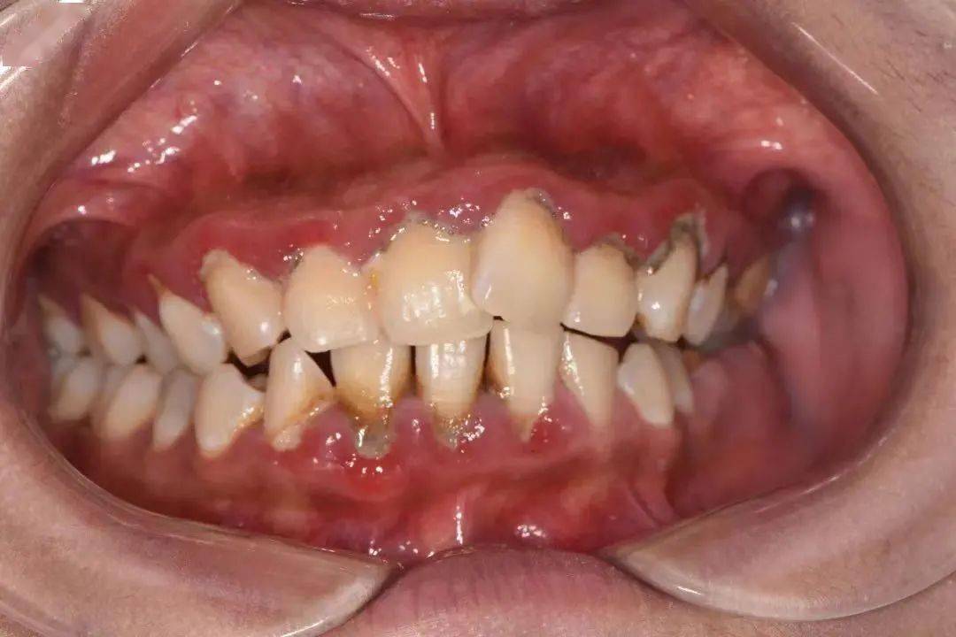 牙结石造成牙龈红肿,出血