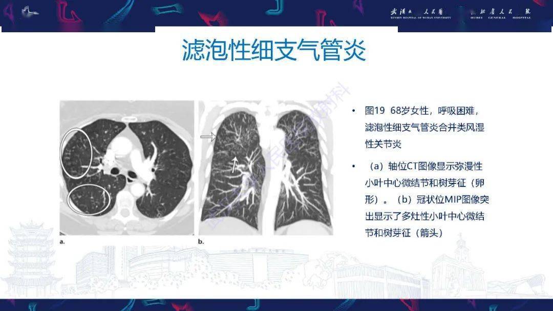 细支气管炎影像诊断