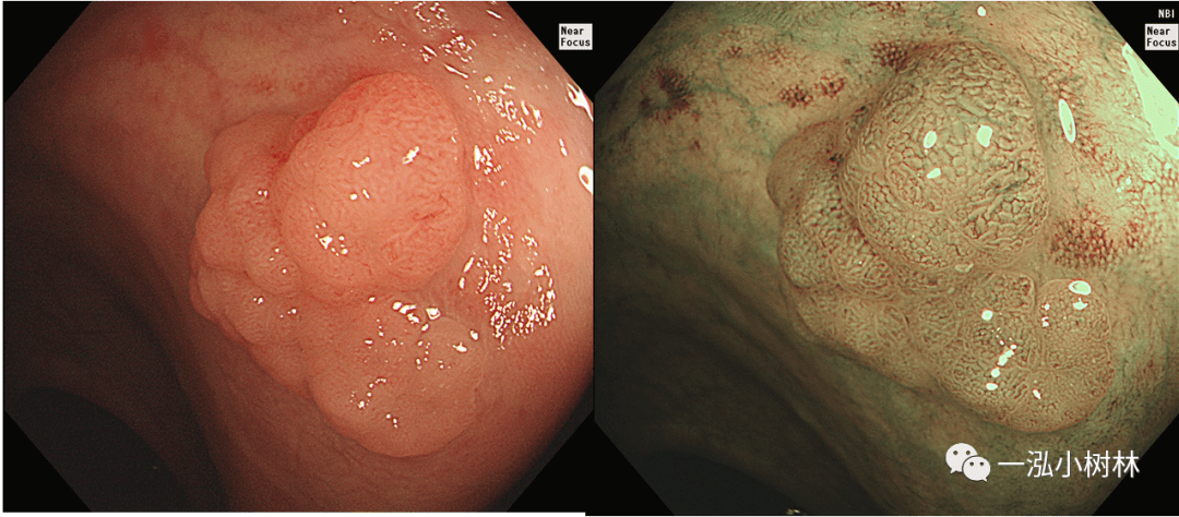 结肠息肉图谱