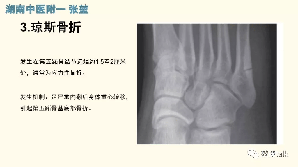 第五跖骨基底骨折——你真的懂吗?