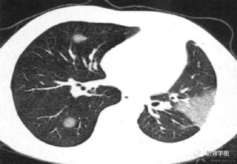 肺部wegener肉芽肿影像征象分析